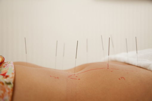 ACUPUNCTURE IN NORCROSS AND SANDY SPRINGS, GA