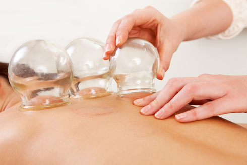 Cupping Therapy, Norcross, Georgia