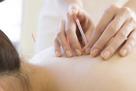 Acupuncturist places needles on a woman's back at Cho Acupuncture in Norcross, Georgia